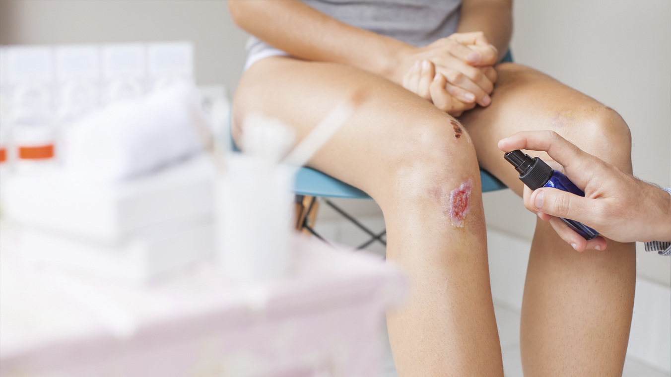 Tratamento para reduzir cicatrizes de feridas com hidrogel estimula o sistema imunológico